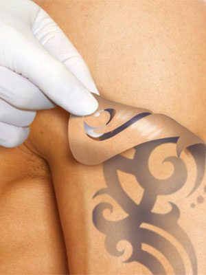 Лазерное удаление татуировок и татуажа