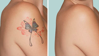 Цены на Лазерное удаление татуировки и татуажа в Киеве